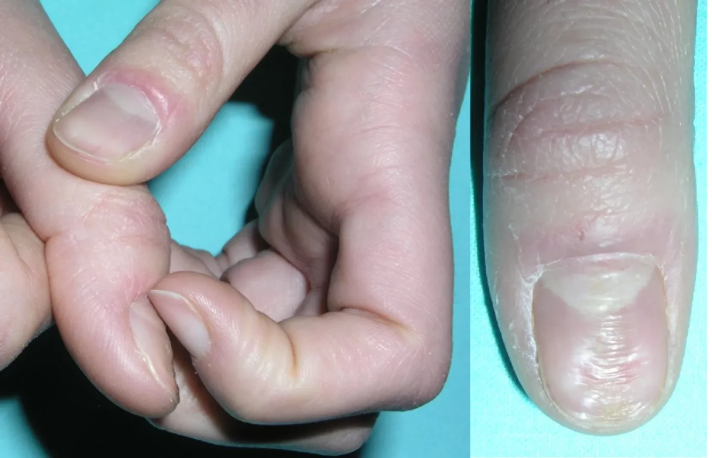 Fig. 5 Movimento di spinta all’indietro cute periungueale, che porta alla comparsa dell’onicodistrofia canaliforme mediana. L’unghia del primo dito mostra un solco longitudinale costellato da tante piccole depressioni trasversali.