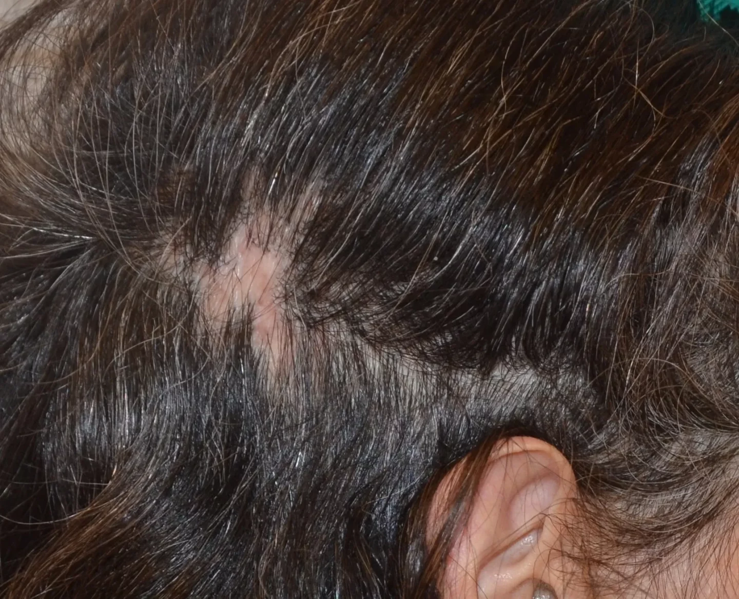 Fig. 5 Lichen plano-pilare: le piccole chiazze di alopecia cicatriziali possono coinvolgere anche le regioni parietali e posteriore del capo.