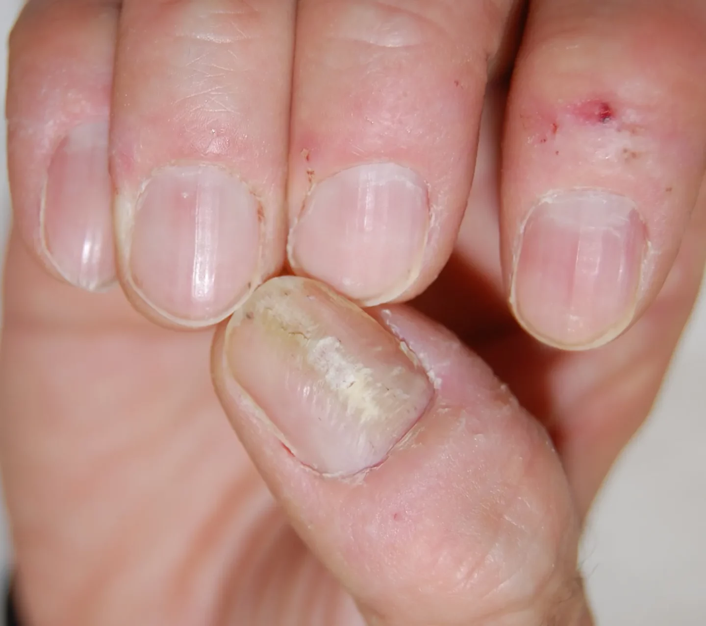 Fig. 6 Onicodistrofia canaliforme mediana: l’unghia del i dito mostra un solco longitudinale della lamina ungueale con molteplici linee trasversali; da notare squame e croste delle altre dita, sempre autoprovocate dal paziente.