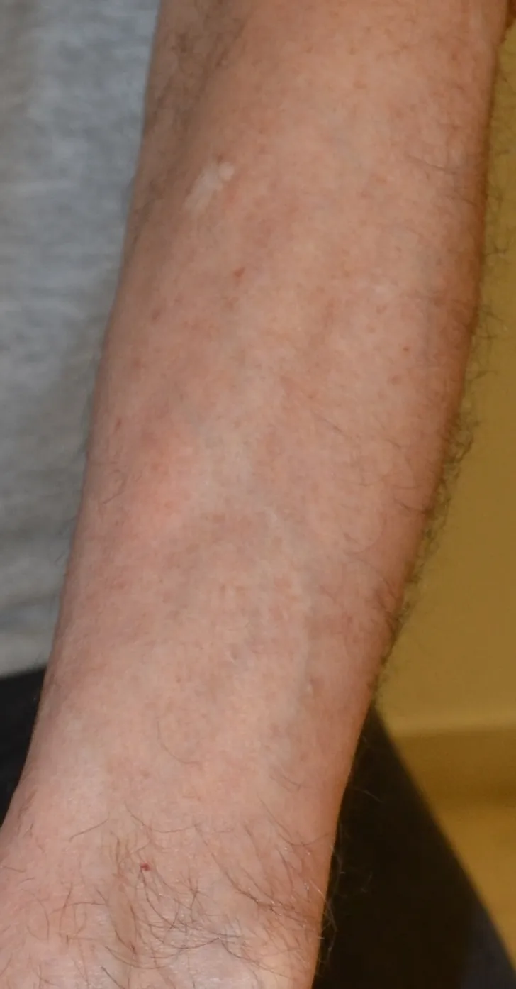 Fig. 6 Lichen plano-pilare con interessamento dei follicoli piliferi delle braccia: chiazze irregolari di alopecia cicatriziale.