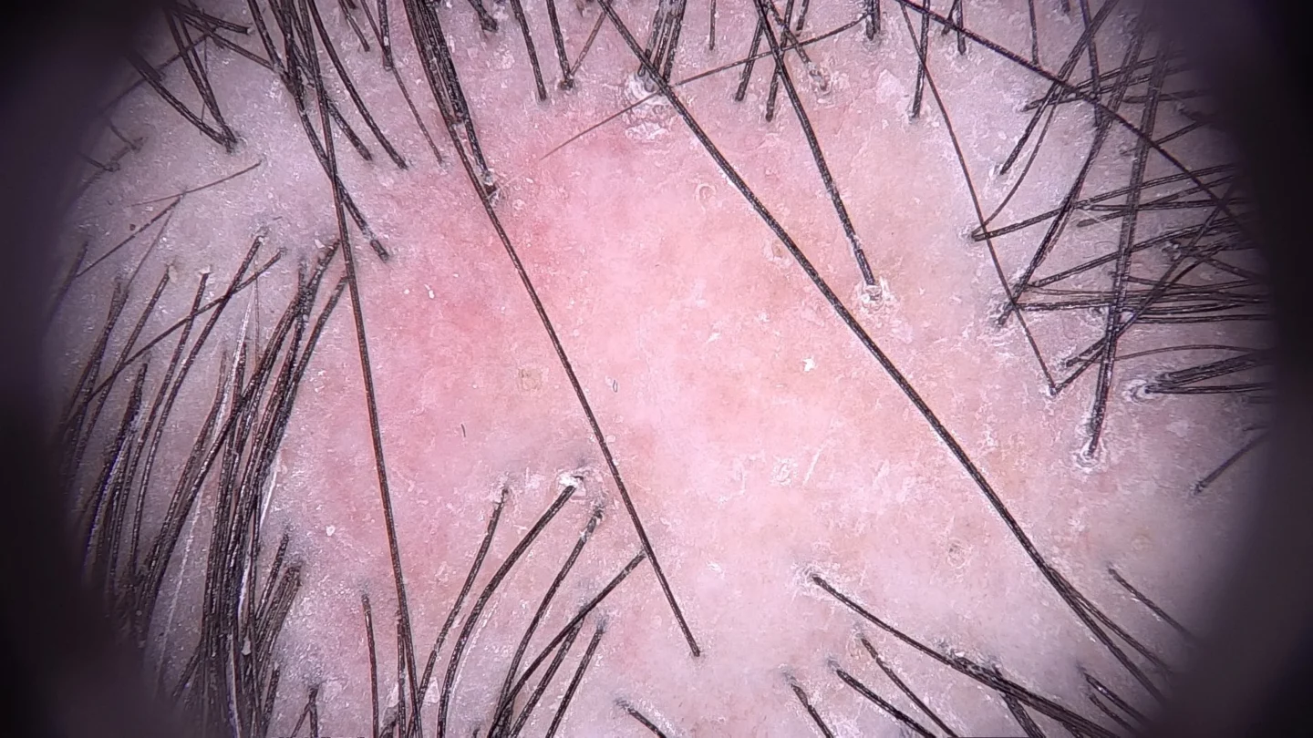 Fig. 7 La tricoscopia del lichen plano-mostra al centro alopecia cicatriziale, con assenza di osti follicolari, e alla periferia eritema e anelli di squame attorno alla emergenza dei capelli.