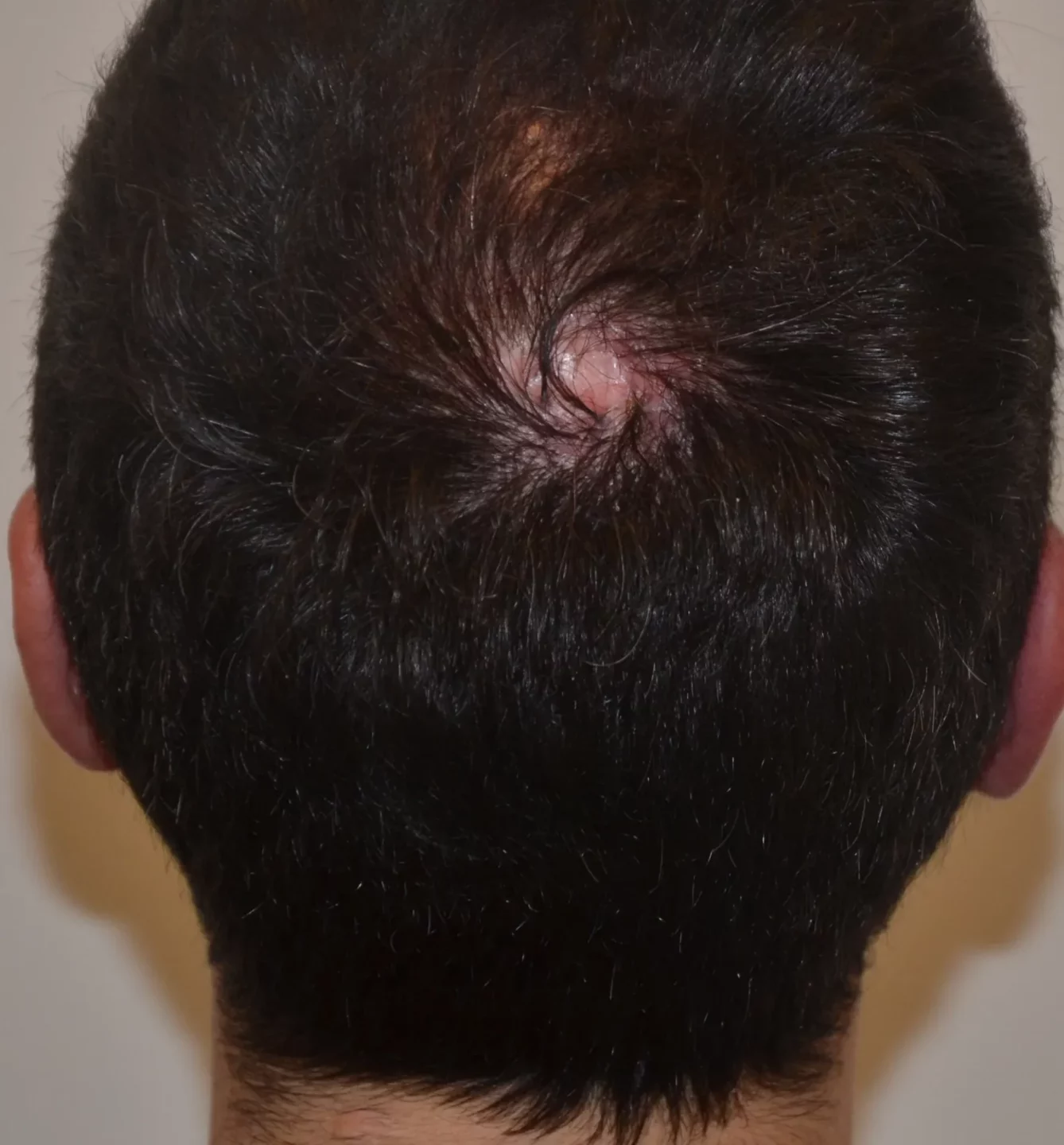 Fig. 8 Follicoliti decalvanti: piccola chiazza di alopecia cicatriziale al vertice del cuoio capelluto