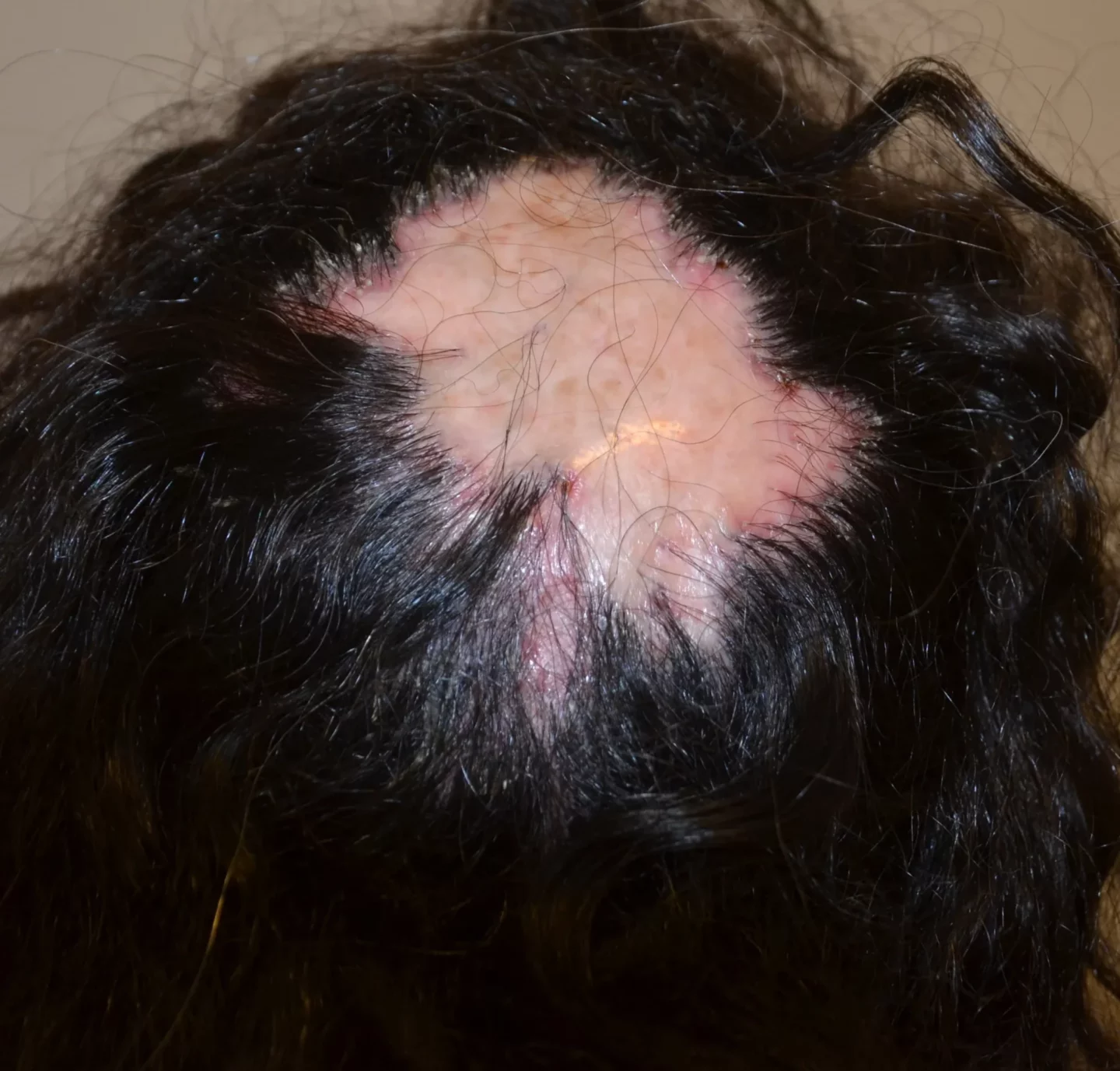 Fig. 9 Follicoliti decalvanti: chiazza di alopecia cicatriziale di grandi dimensioni al vertice del cuoio capelluto, con alla periferia segni infiammatori