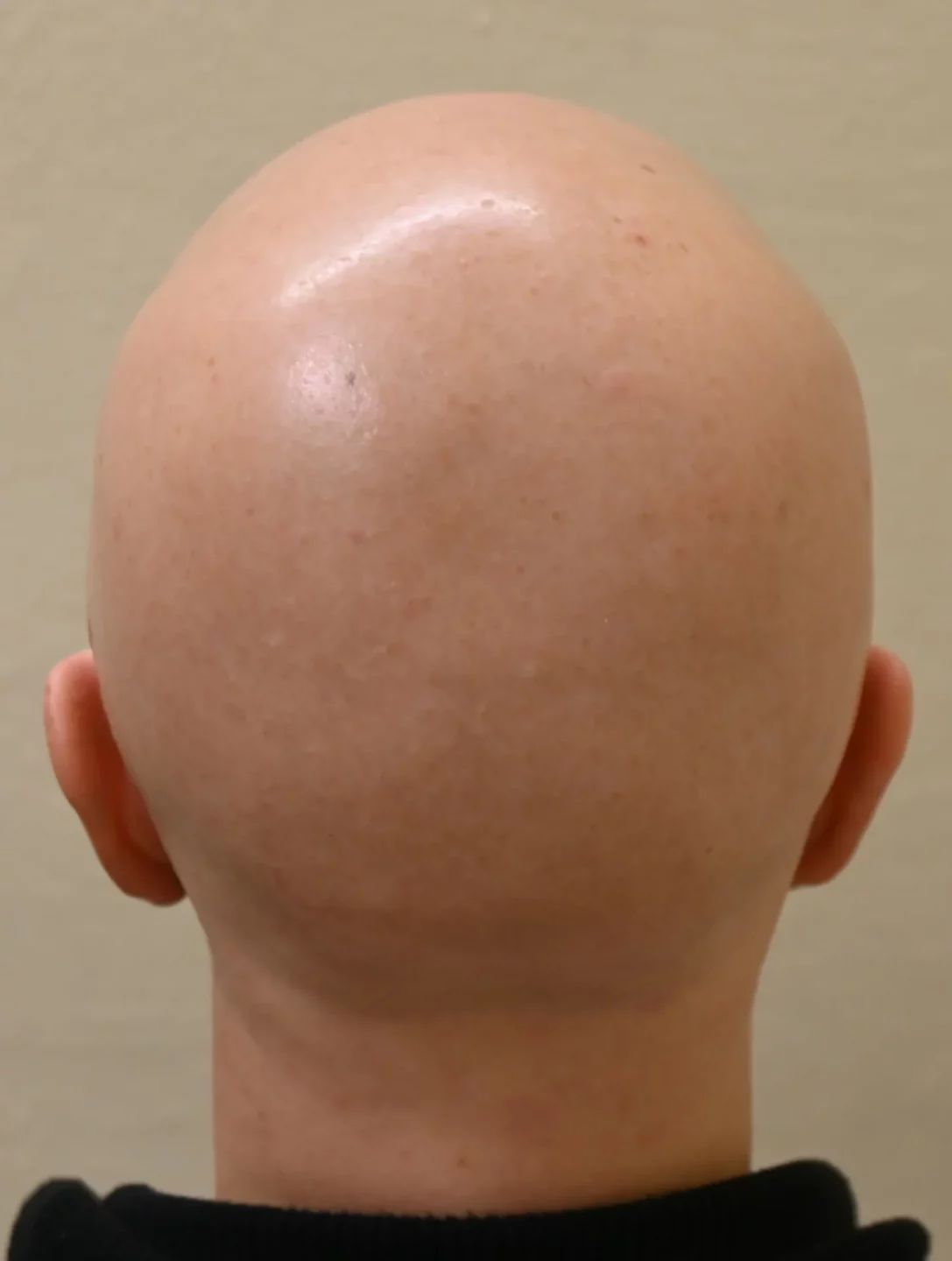 Fig. 1 Alopecia areata totale (SALT 100)