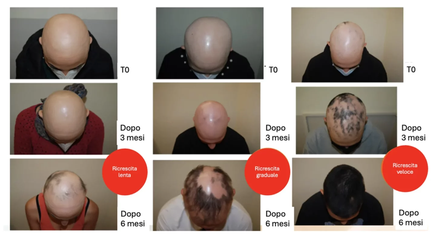 Fig. 2 Diverse velocità di ricrescita dei capelli in pazienti con alopecia areata durante trattamento con Jack inibitori