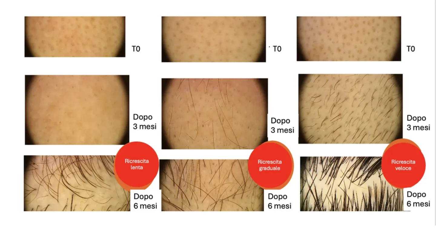Fig. 3 La tricoscopia degli stessi pazienti di Figura 2 mostra segni di ricrescita prima che siano visibili ad occhio nudo.