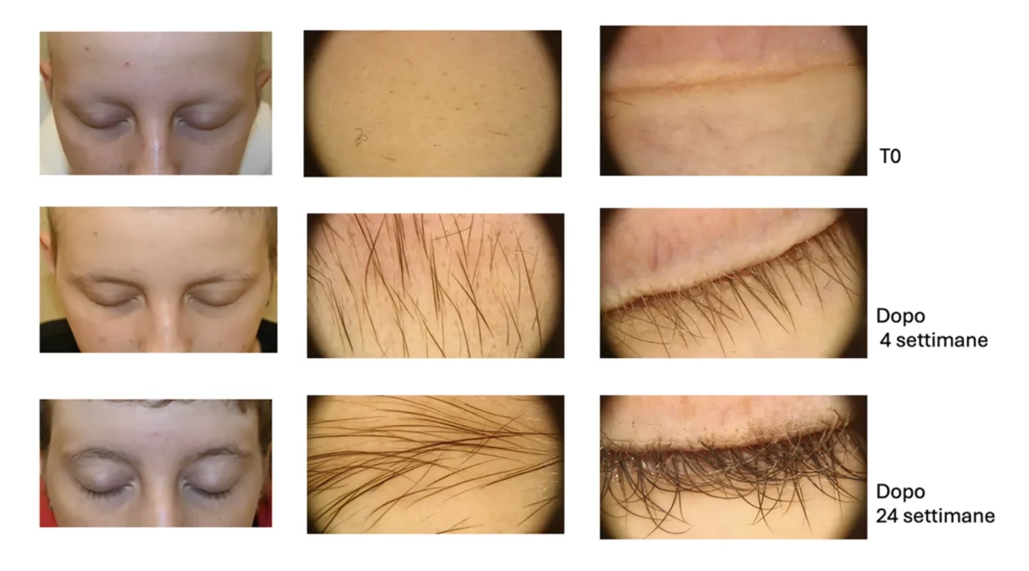 Fig. 4 Crescita di ciglia e sopracciglia in alopecia areata durante il trattamento con JAK inibitori. Spesso la ricrescita di queste due aree pilifere precede la ricrescita dei capelli.
