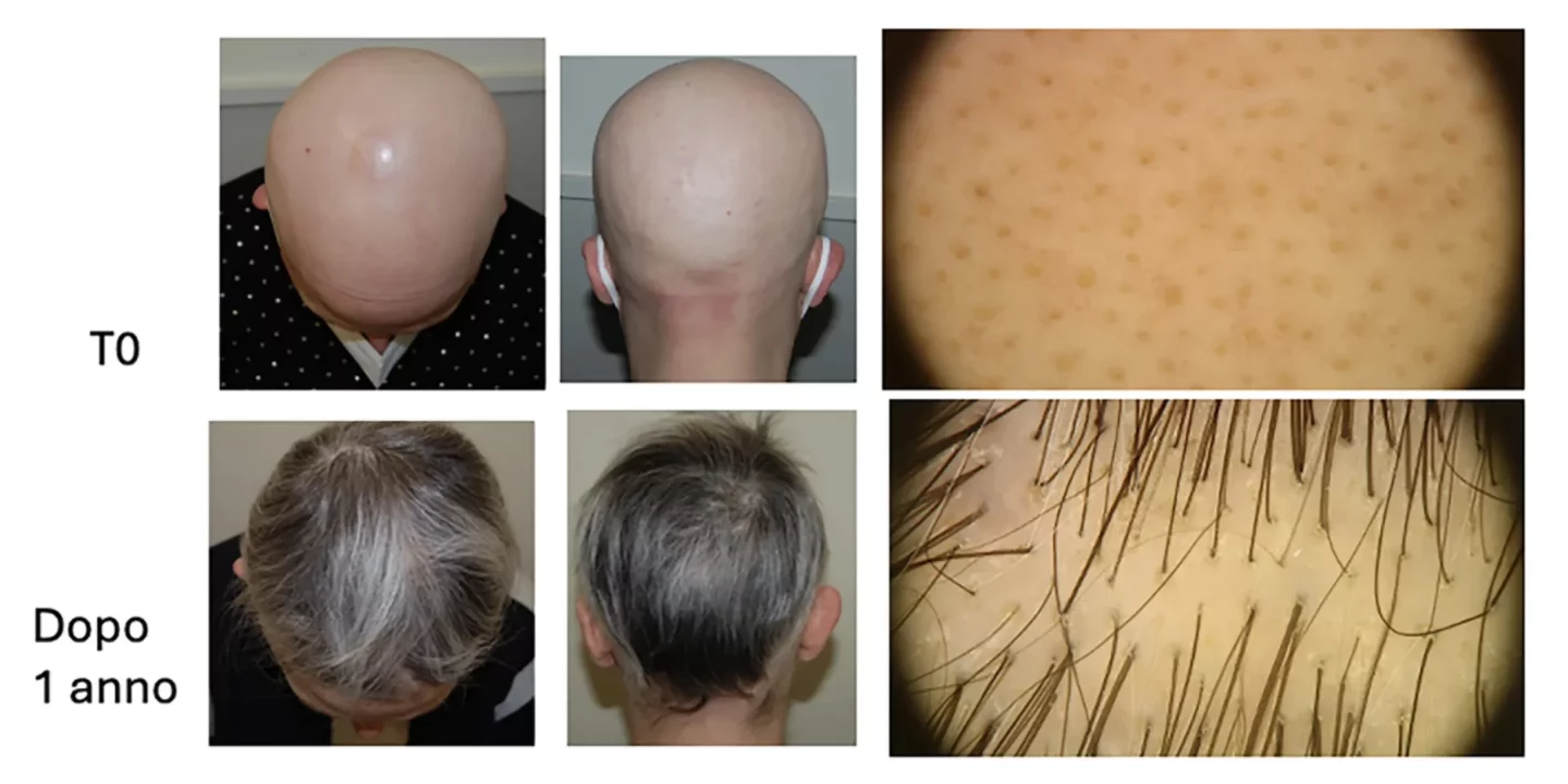 Fig. 5 Ricrescita completa dei capelli in alopecia areata grave dopo un anno di trattamento con JAKi.