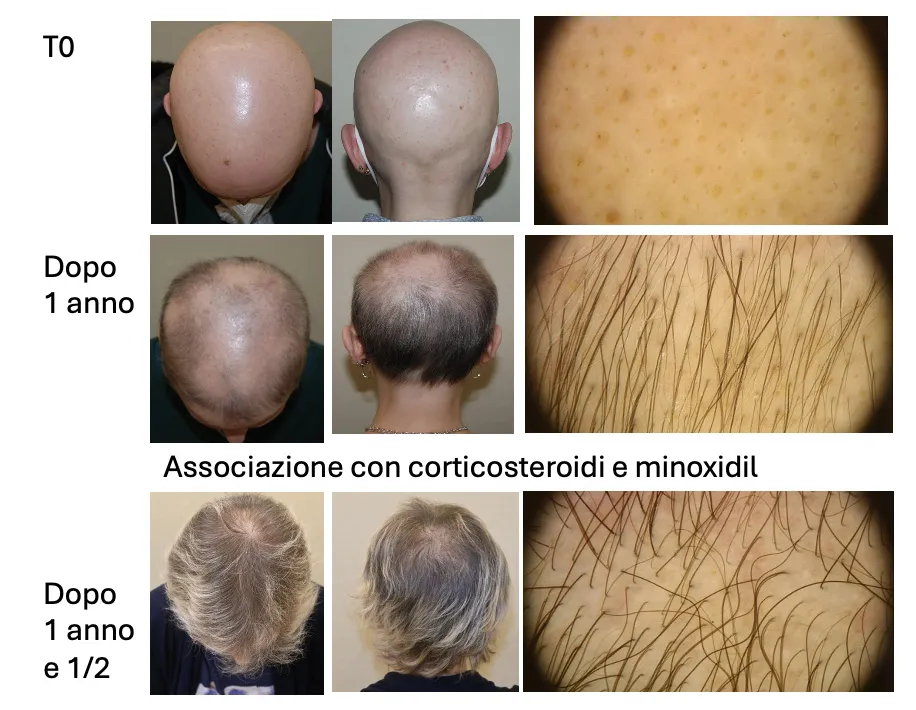 Fig. 6 Ricrescita parziale dei capelli in alopecia areata grave dopo un anno di trattamento con JAKi. L’associazione con altri farmaci ha potenziato l’attività del JAK inibitore portando a una ricrescita completa dopo 1 anno e mezzo.