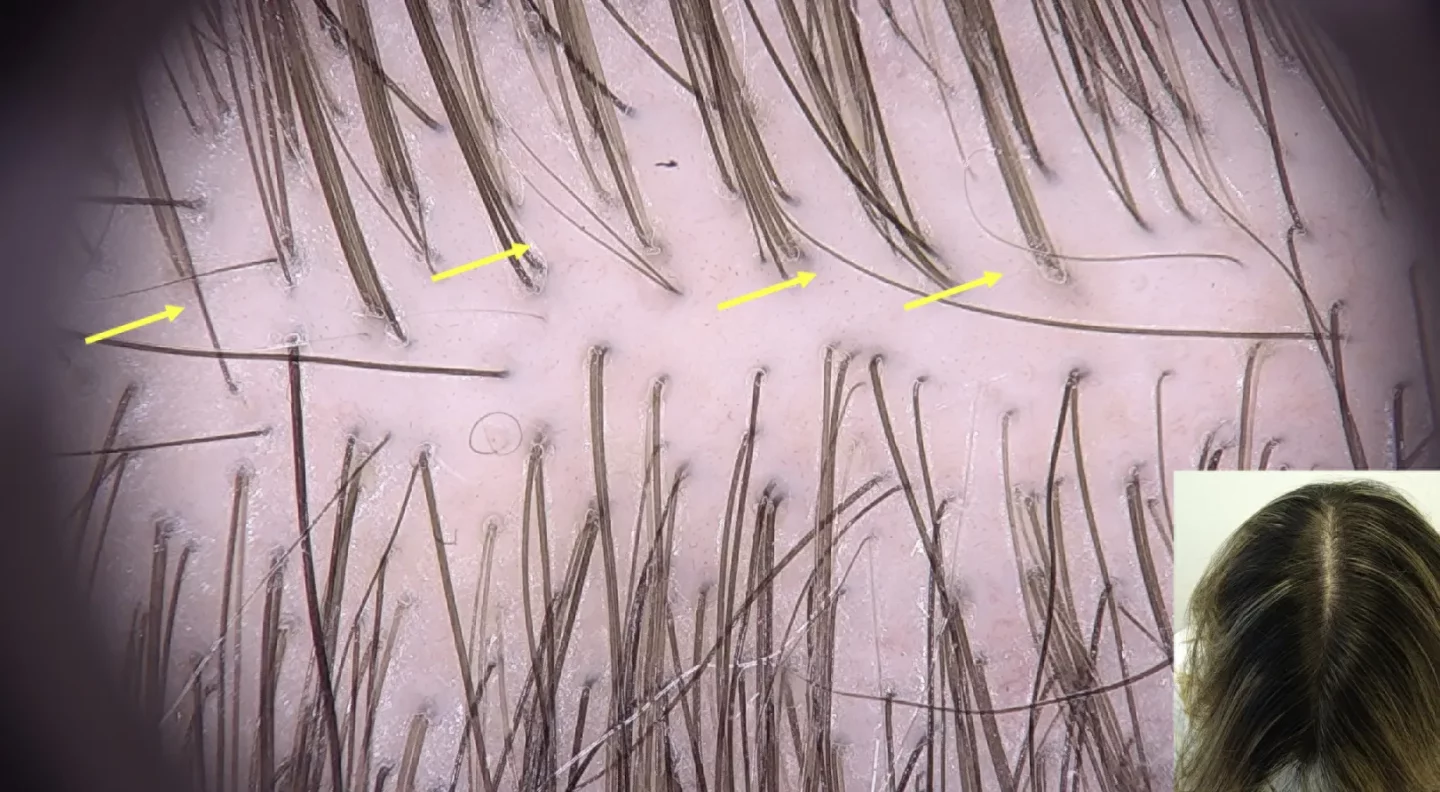Fig.2 Telogen effluvium stagionale: la chioma ha una normale densità e la tricoscopia mostra un normale numero e diametro dei capelli, presenza di capelli corti in ricrescita (indicati dalle frecce gialle).
