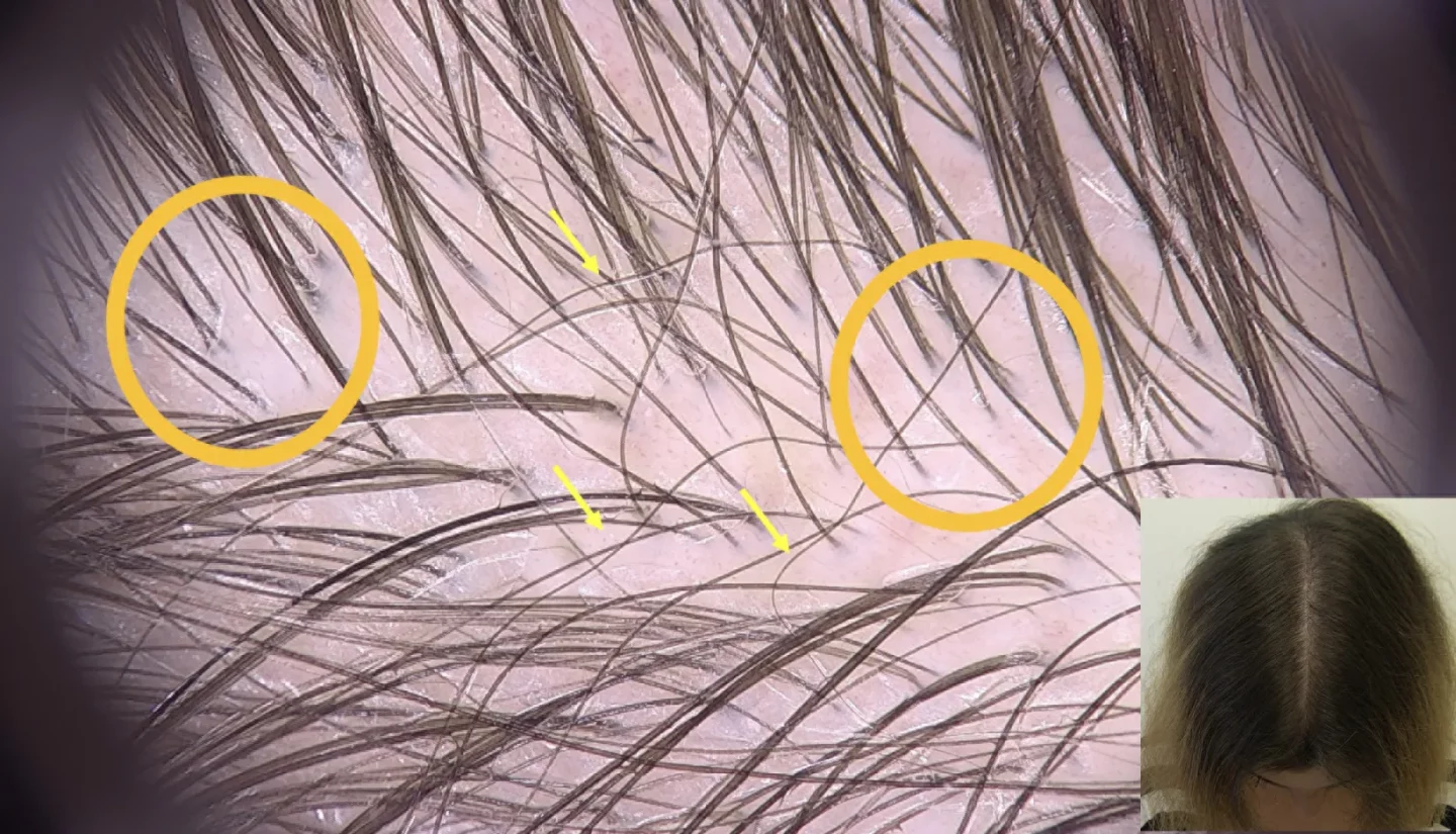 Fig.3 Telogen effluvium stagionale in paziente con alopecia androgenetica lieve: la chioma mostra un allargamento ella riga nel mezzo e la tricoscopia mostra capelli corti in ricrescita (indicati dalle frecce gialle) e variabilità del diametro dei capelli (ben visibile nei cerchi arancioni). Da notare la pigmentazione marrone del cuoio capelluto, successiva alla esposizione solare.