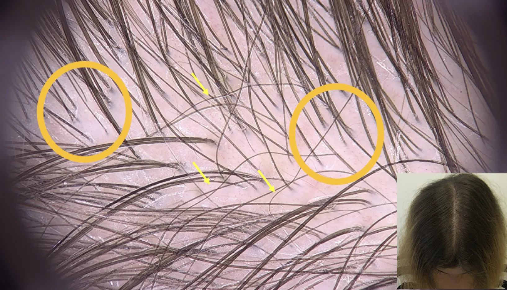 Fig.3 Telogen effluvium stagionale in paziente con alopecia androgenetica lieve: la chioma mostra un allargamento ella riga nel mezzo e la tricoscopia mostra capelli corti in ricrescita (indicati dalle frecce gialle) e variabilità del diametro dei capelli (ben visibile nei cerchi arancioni). Da notare la pigmentazione marrone del cuoio capelluto, successiva alla esposizione solare.
